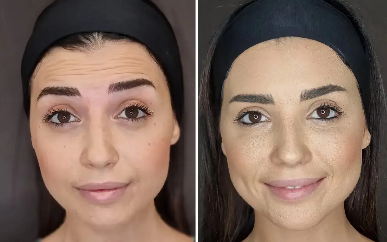 Confronto botox viso prima e dopo: fronte più liscia e rughe d'espressione attenuate.