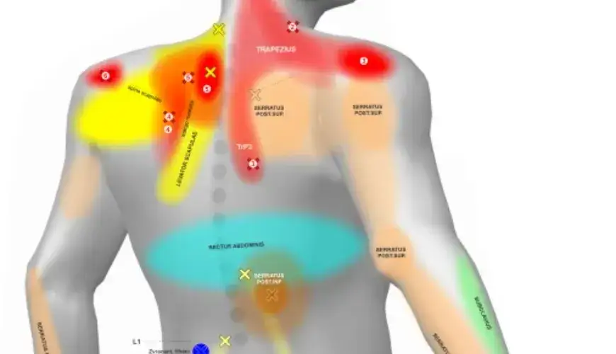 Mapa bólu ciała z zaznaczonymi obszarami bólu kręgosłupa i stawów