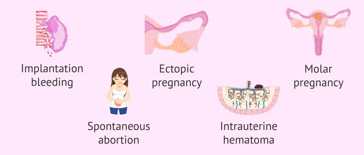 Ilustracje przedstawiające objawy poronienia: krwawienie implantacyjne, ciążę pozamaciczną, poronienie samoistne, krwiak wewnątrzmaciczny, ciążę zaśniadową.