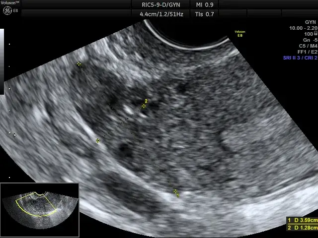 USG endometrium tr&oacute;jliniowe