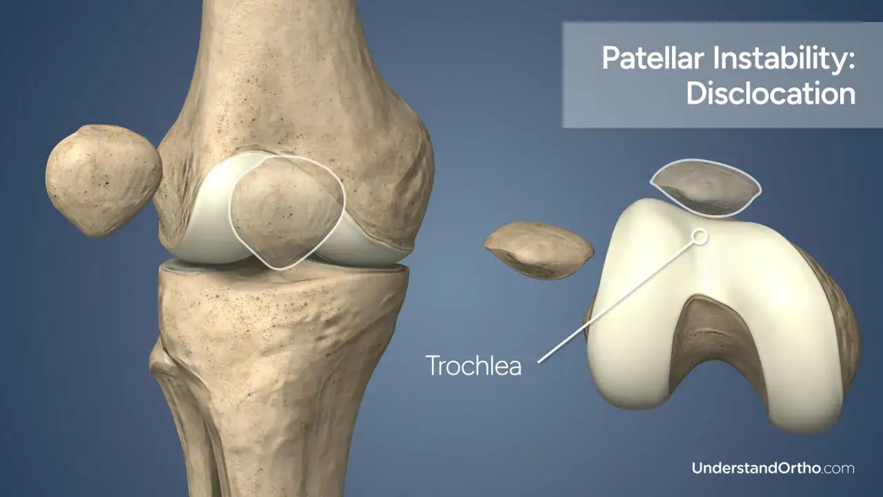 Kniegelenk mit Patella-Instabilität. Die Trochlea ist sichtbar, während die Patella aus der Führung gerutscht ist. MPFL-Plastik kann helfen.