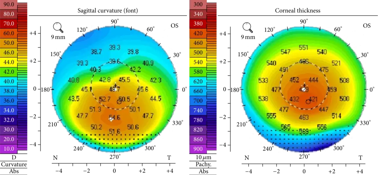 Dwa obrazy topograficzne rogówki. Lewy pokazuje nieprawidłowości grubości rogówki, prawy krzywiznę. Objawy stożka rogówki mogą być widoczne na takich badaniach.