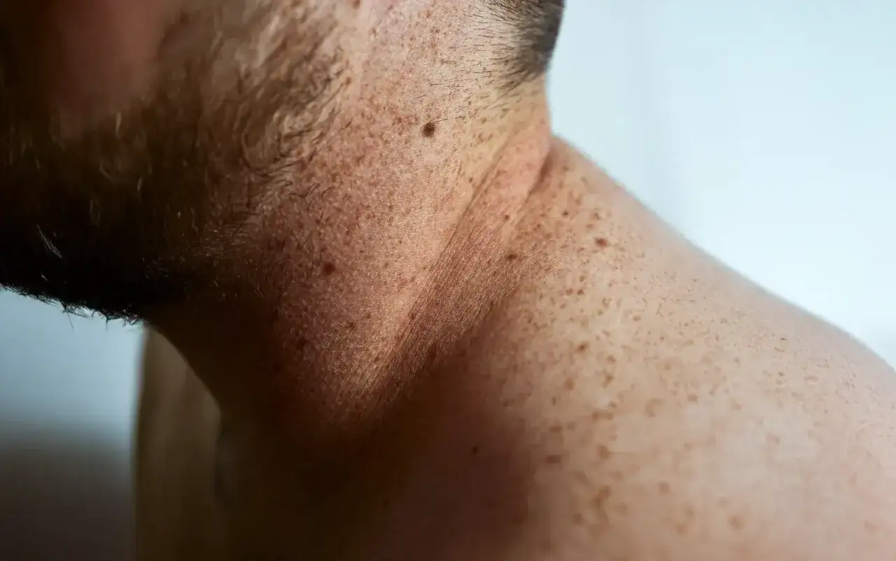Gros plan sur la peau d'un homme, révélant de nombreuses taches brunes, comme des grains de beauté et des taches de rousseur, sur son cou et son épaule.