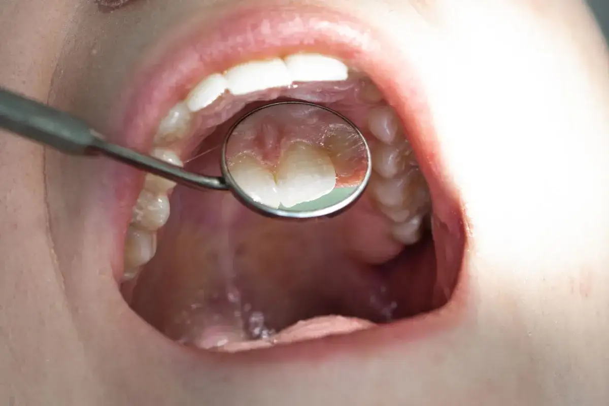 Zęby w odbiciu lusterka dentystycznego. Czy kamień nazębny śmierdzi? Zobacz, jak wygląda jama ustna podczas badania.