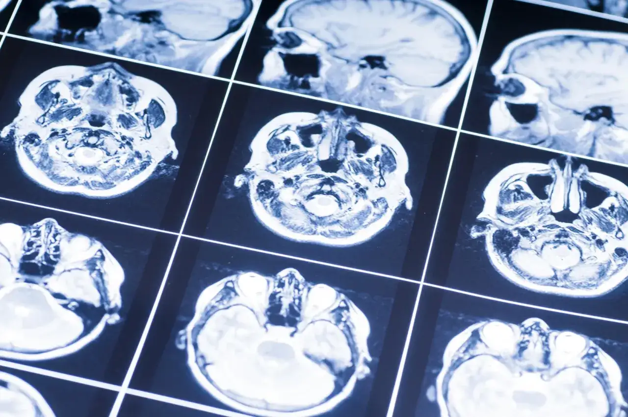 Przekroje mózgu na rezonansie magnetycznym. Obraz może pomóc w diagnostyce oponiak objawy, ukazując strukturę tkanki mózgowej.