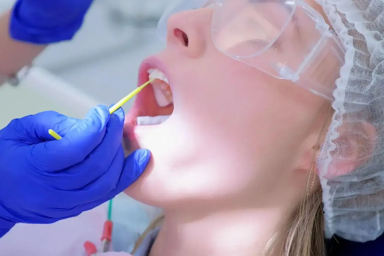 Dentysta w niebieskich rękawiczkach aplikuje żel podczas fluoryzacji zębów u pacjentki w okularach ochronnych.