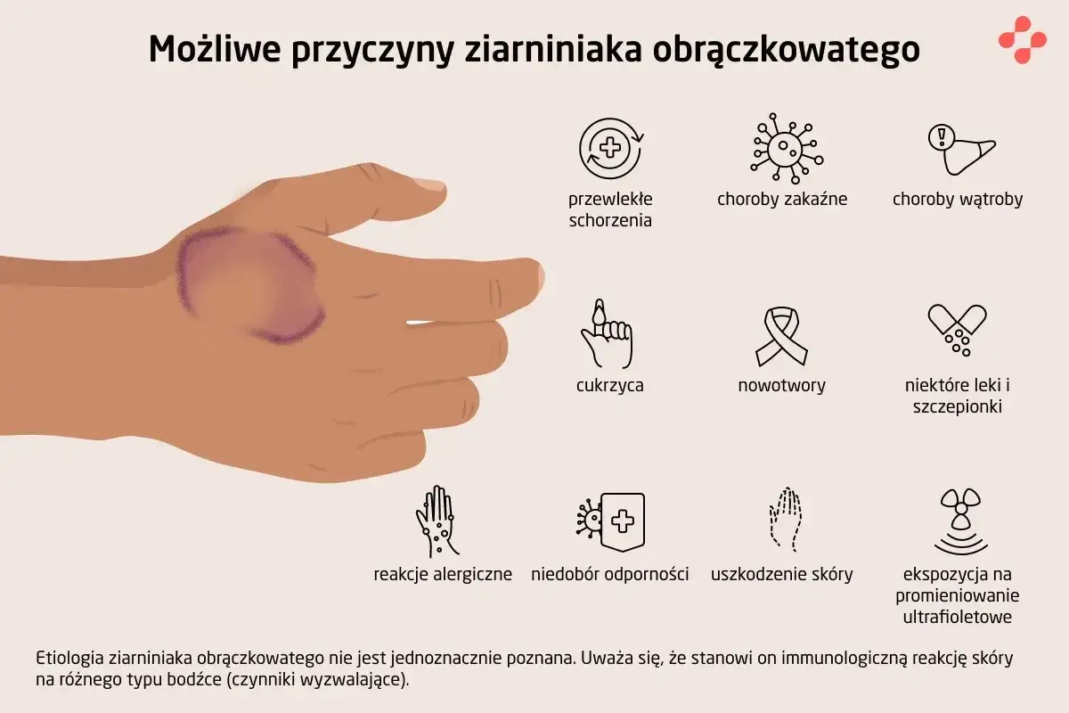 Dłoń z widocznym ziarniniakiem obrączkowatym. Obok ikony symbolizujące możliwe przyczyny: choroby, cukrzyca, nowotwory, leki, alergie, uszkodzenia skóry, promieniowanie UV.