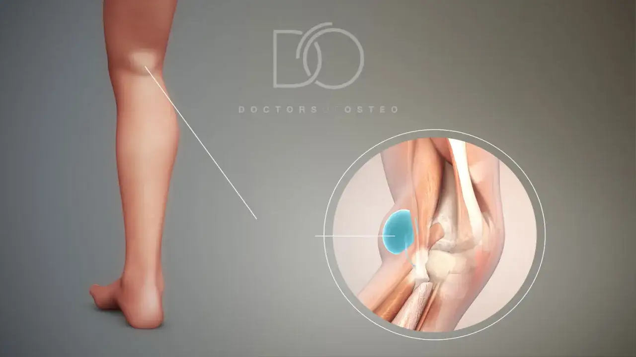 Anatomia kolana z widoczną torbielą Bakera. Laserowe leczenie torbieli Bakera to innowacyjna metoda.