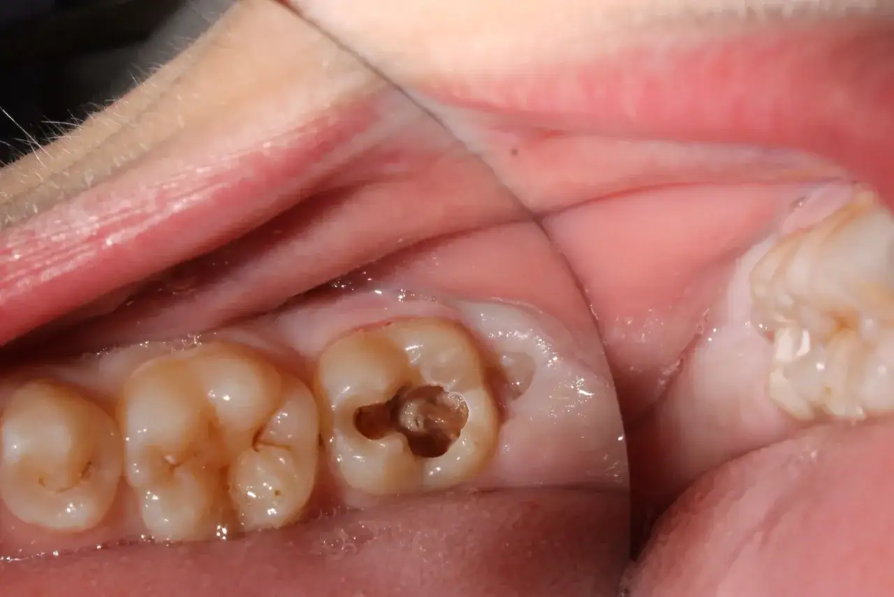 Diente con una cavidad oscura y profunda, indicativo de caries avanzada. Se observan otros dientes cercanos y enc&iacute;as.