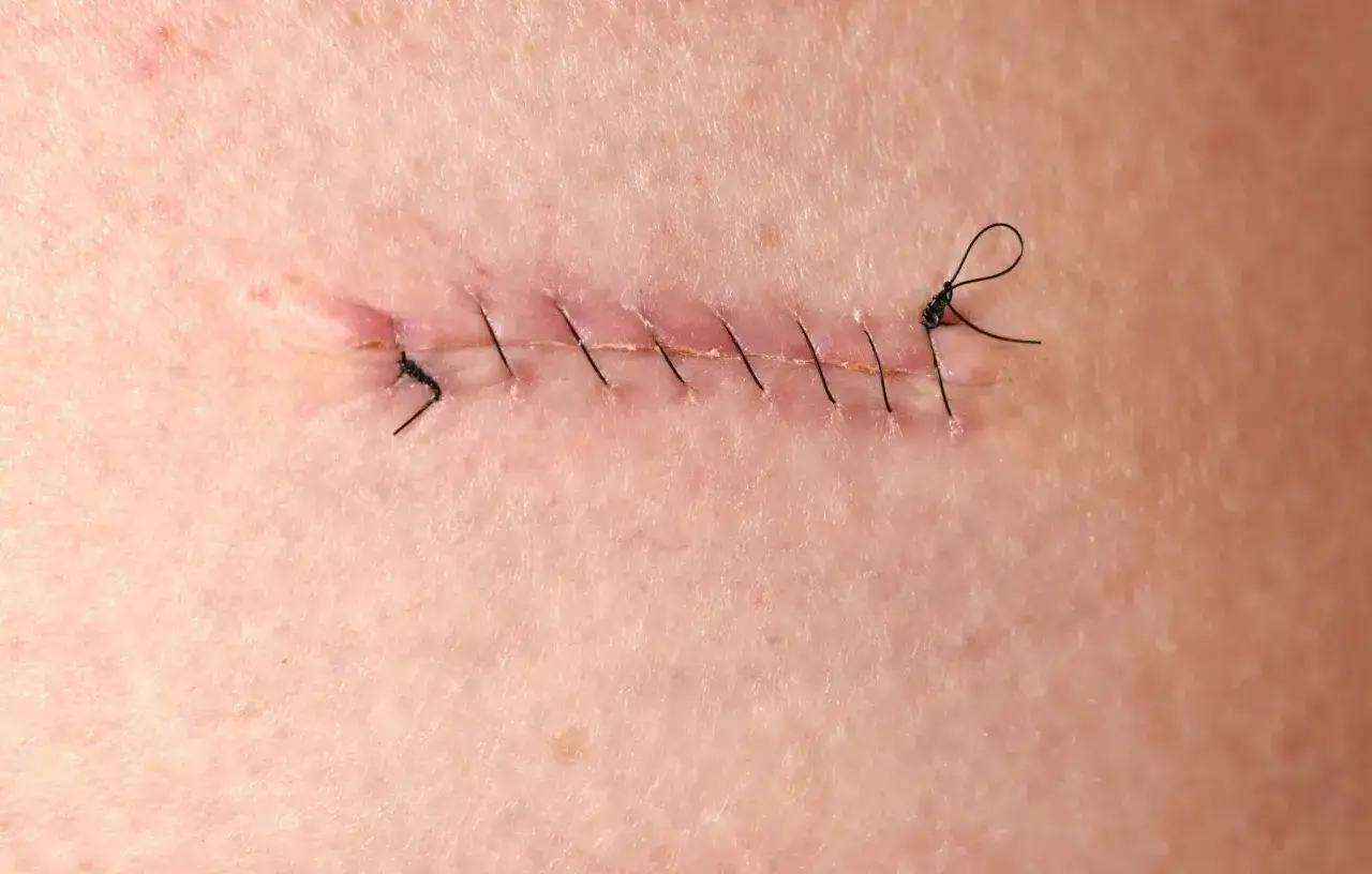 Cicatrice suturée avec des points noirs. On compte environ 6 points de suture par cm.