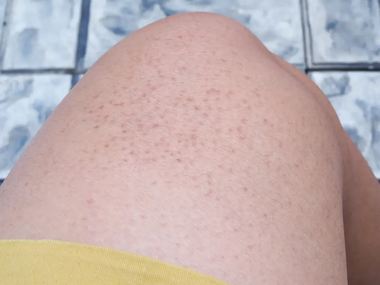 Piel con queratosis pilaris, pequeñas protuberancias rojas y ásperas. Algunas personas notan que su queratosis pilaris empeora al consumir gluten.