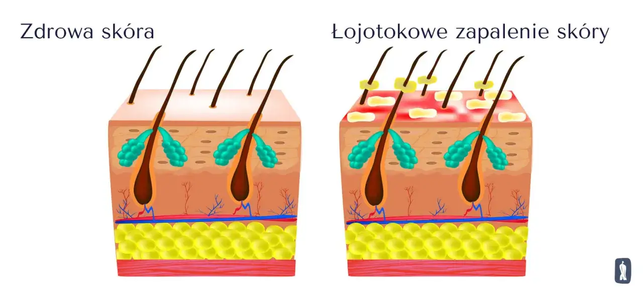 Porównanie zdrowej skóry i łojotokowego zapalenia skóry. Alpicort E może pomóc w leczeniu zmian.