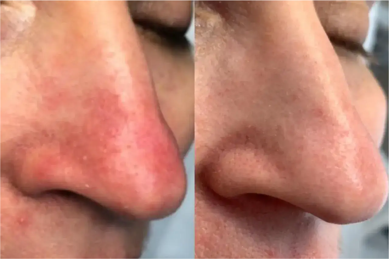 Comparaison avant/après d'un nez rouge, montrant une amélioration. Que faire pour un nez rouge ?