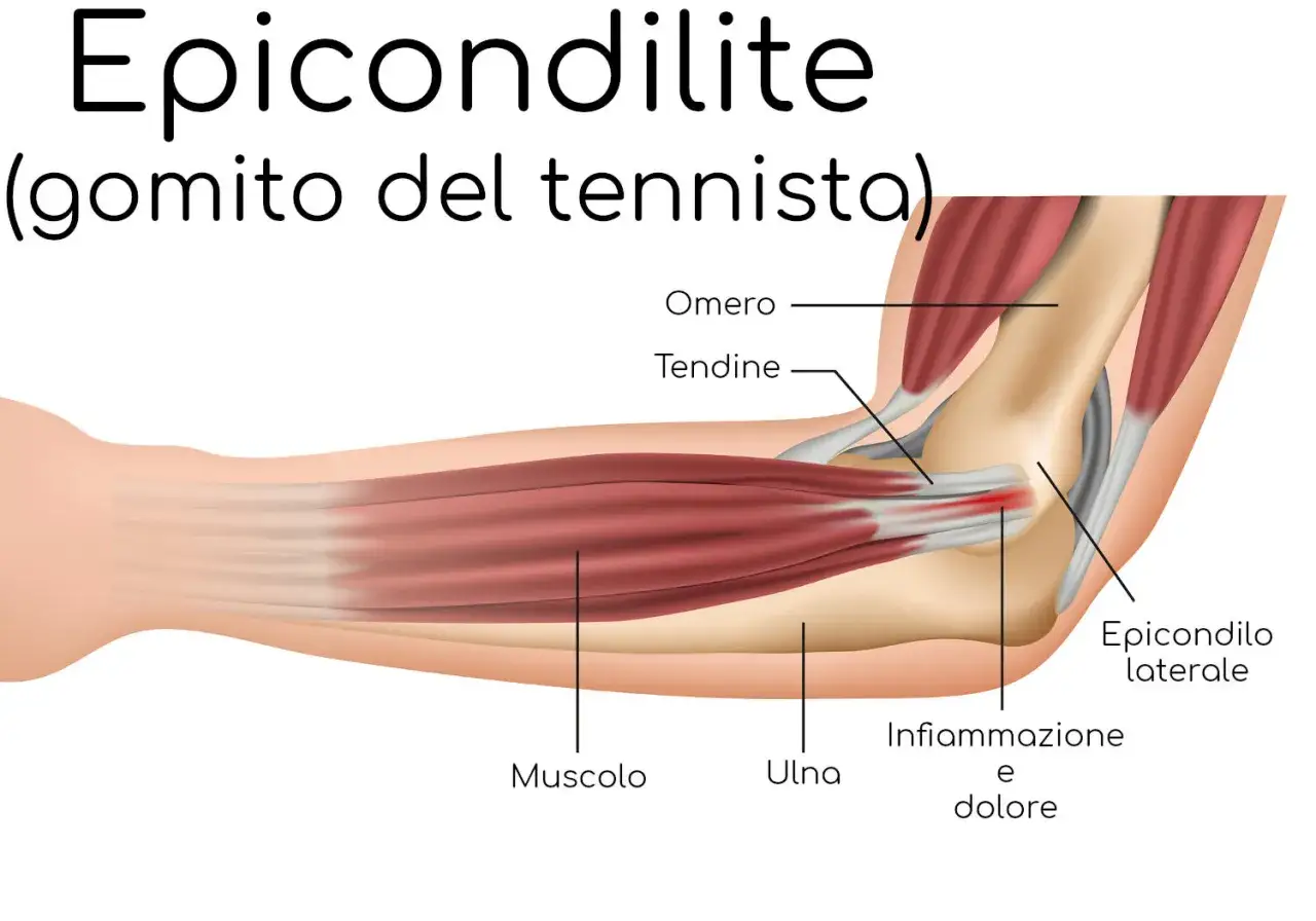 Illustrazione anatomica del gomito che mostra infiammazione e dolore, tipici dell'epicondilite (gomito del tennista).