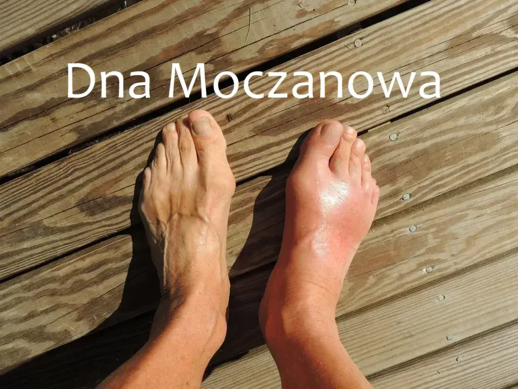 diagnostyka dny moczanowej i haluksów