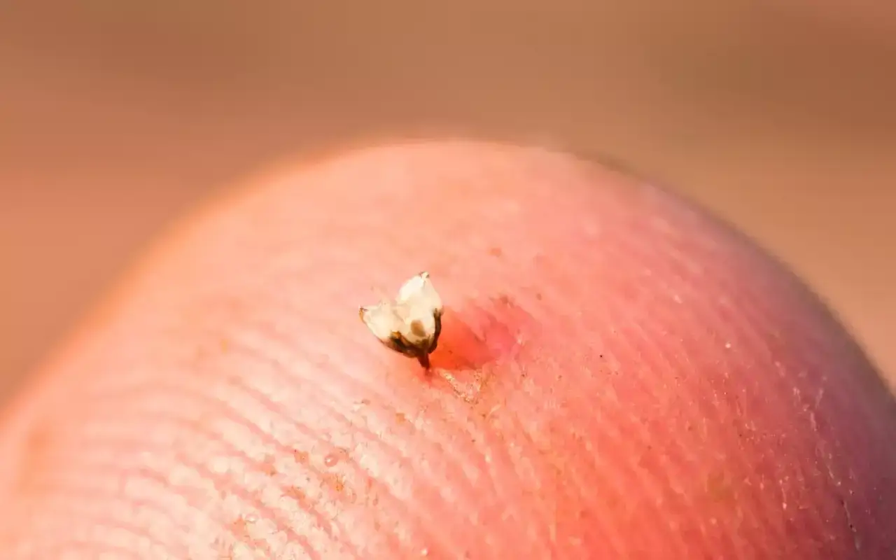 Ein kleiner, wei&szlig;er Stachel ragt aus einer roten Fingerspitze. Ein Stich! Was tun bei einem Bienestich?