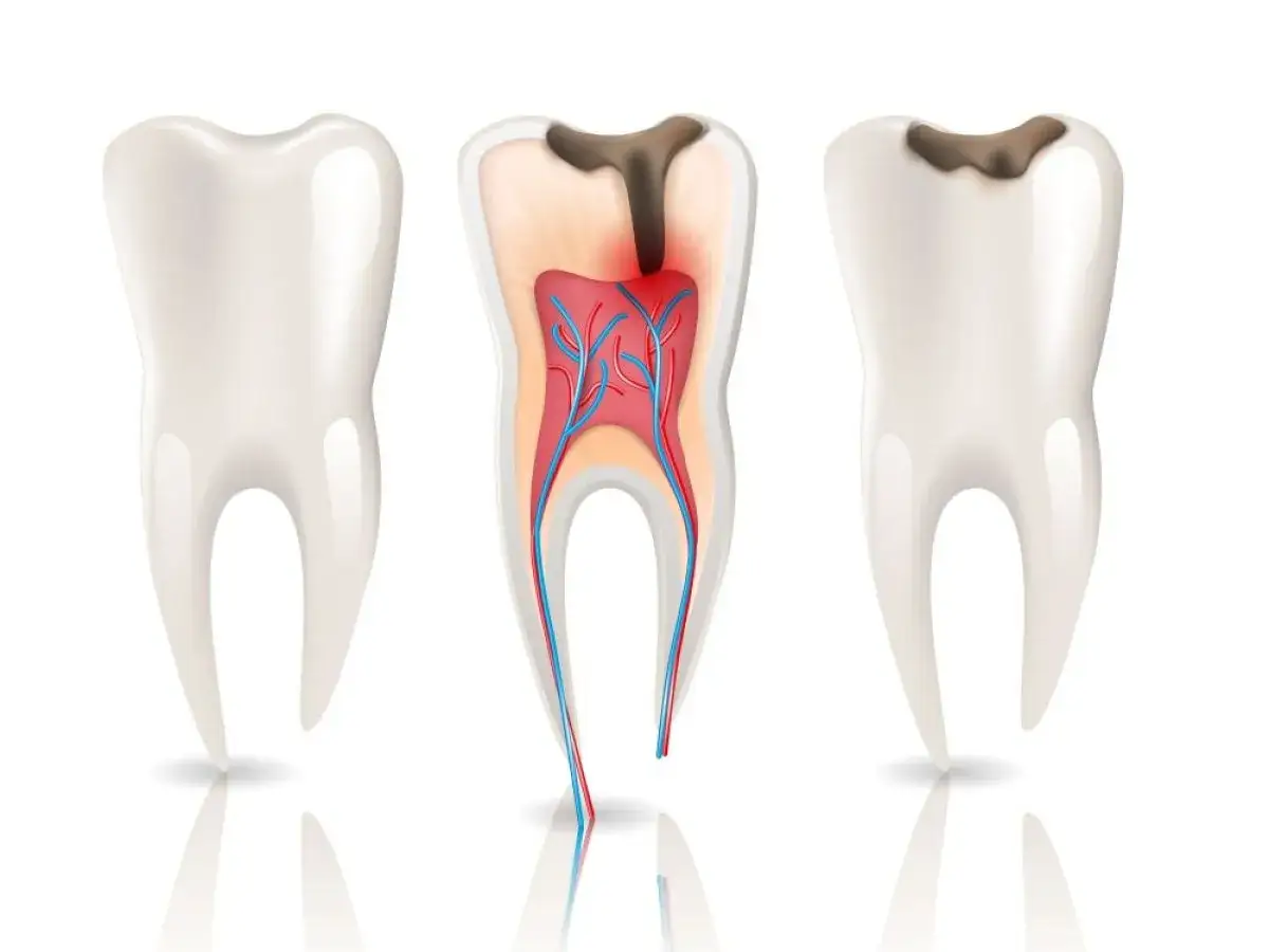 Denti sani e un dente con carie avanzata che mostra la polpa infiammata. Le carie cause sono visibili.