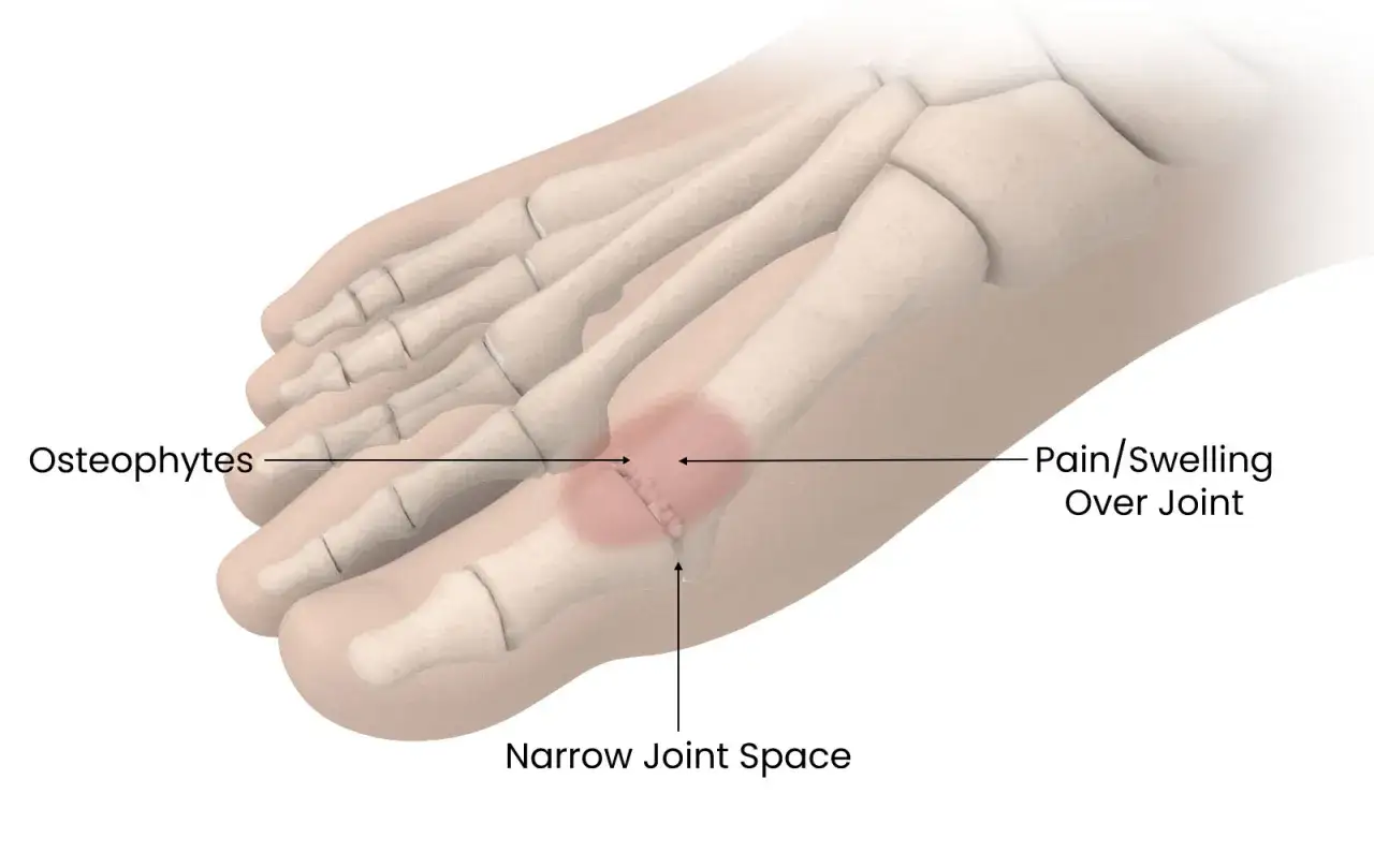 Illustrazione anatomica del piede che mostra osteofiti e spazio articolare ristretto, causa di dolore alle dita dei piedi.