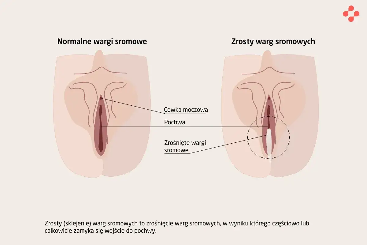 Ilustracja porównuje normalne wargi sromowe z zrośniętymi, pokazując zmniejszenie warg sromowych i częściowe zamknięcie pochwy.