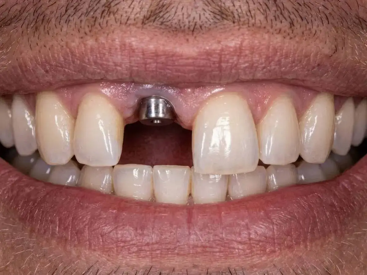 Implant zębowy, przygotowany pod protezę częściową na NFZ. Uśmiech odzyskuje pełnię.