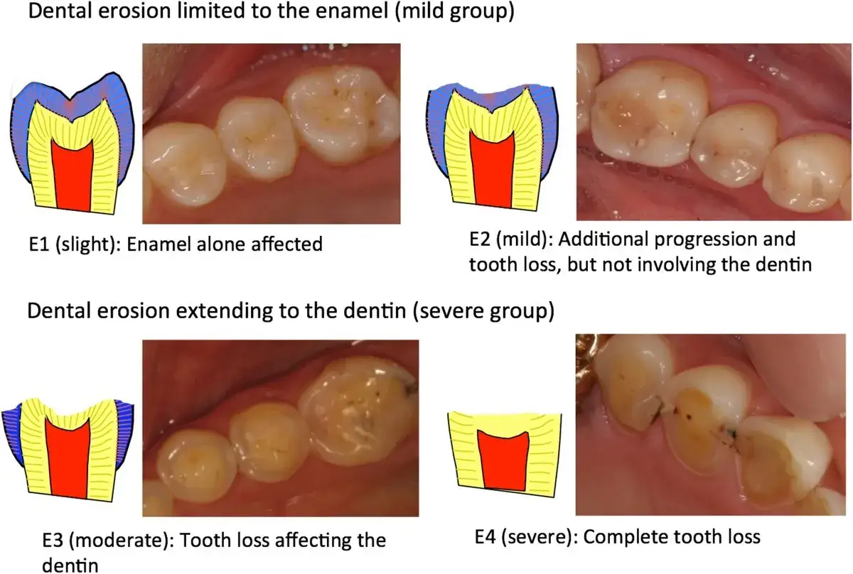Denti erosi, da lieve a grave, con perdita di smalto e dentina. L'anoressia può causare gravi danni ai denti.