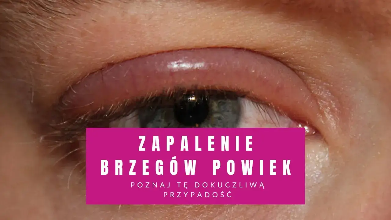 Zapalenie brzegów powiek, często spowodowane przez roztocza Demodex. Skuteczne demodex leczenie jest kluczowe dla ulgi.