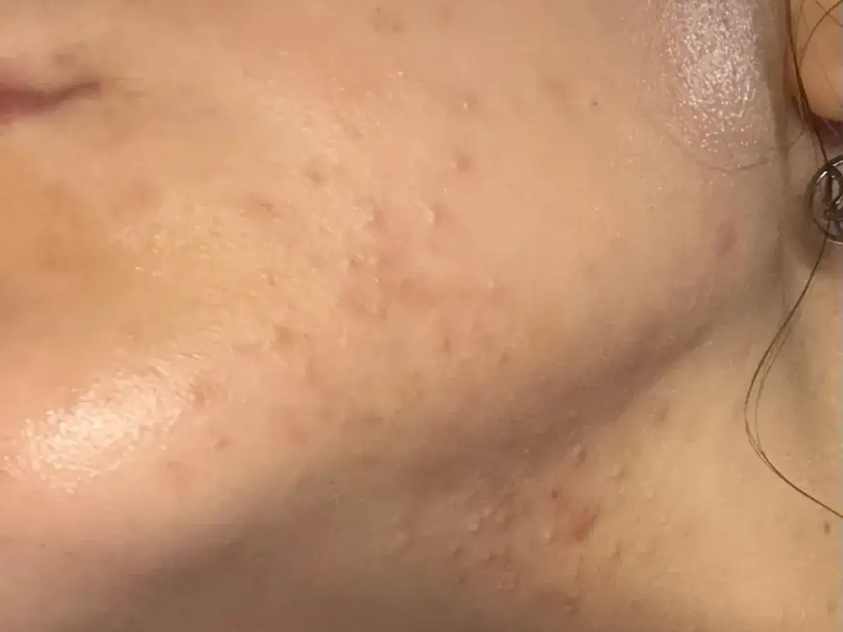 Primo piano del viso con brufoli da stress, piccoli e rossi, che compaiono sulla guancia.