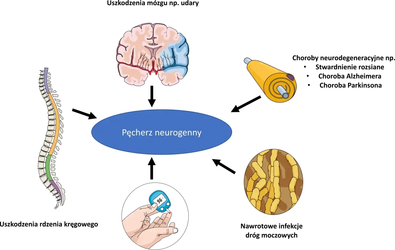 Ilustracja przedstawia różne rodzaje nietrzymania moczu, w tym pęcherz neurogenny, uszkodzenie mózgu, rdzenia kręgowego, nerwów i cukrzycę.