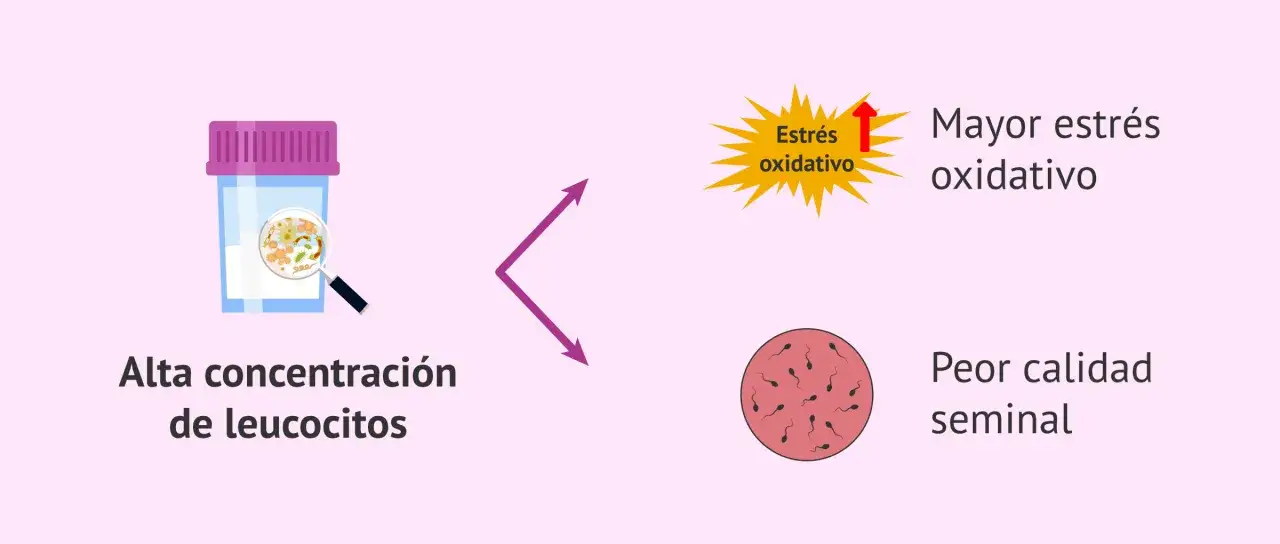 Recipiente con alta concentraci&oacute;n de leucocitos, que indica mayor estr&eacute;s oxidativo y peor calidad seminal.