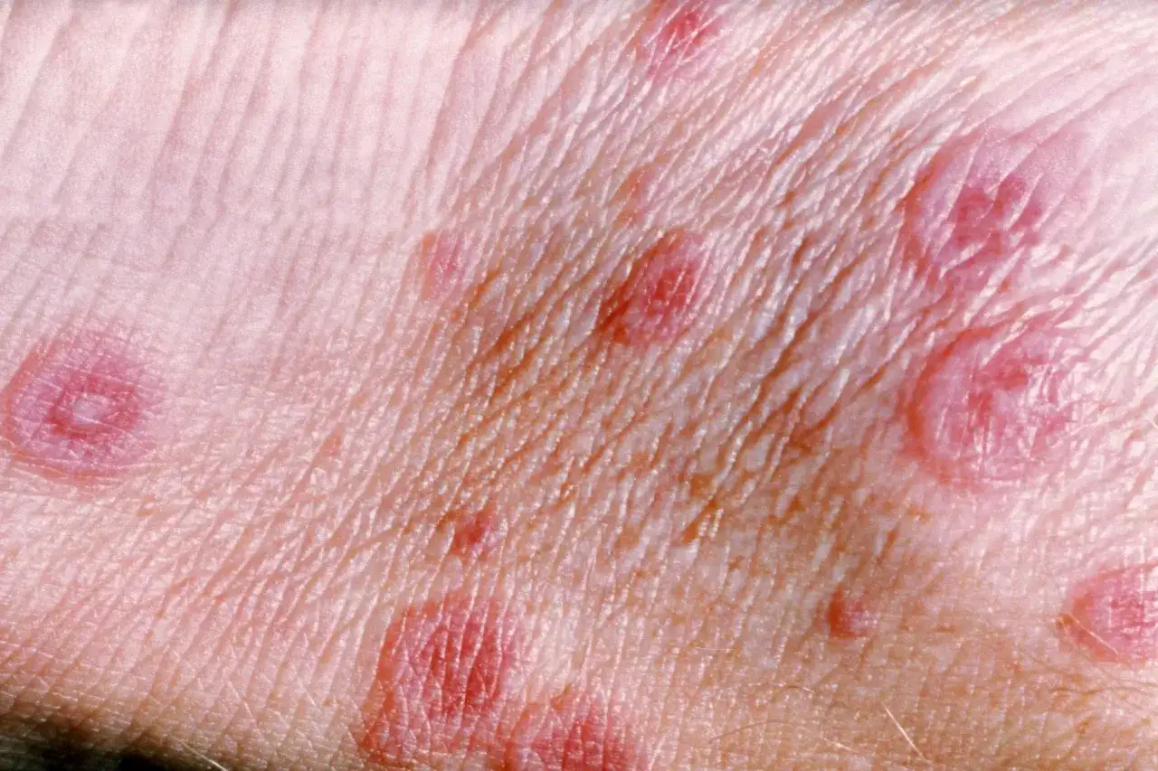 Hautveränderungen, die auf Erythema exsudativum multiforme hindeuten: rote, ringförmige Läsionen mit zentraler Aufhellung auf der Haut.