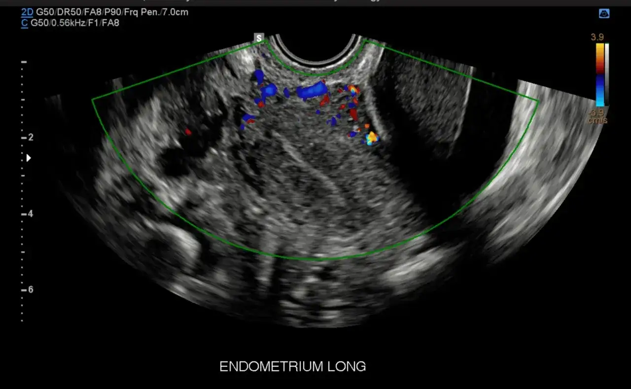 Ecografia pelvica con evidenza di vascolarizzazione anomala, possibile indicazione di tumore ovaio.