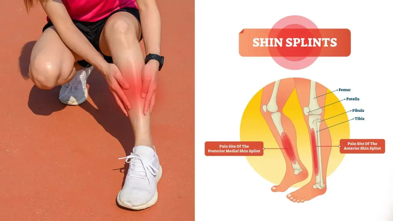 Läuferin hält schmerzendes Schienbein vorne. Grafik zeigt Schienbeinkantensyndrom (Shin Splints) und Schmerzstellen.