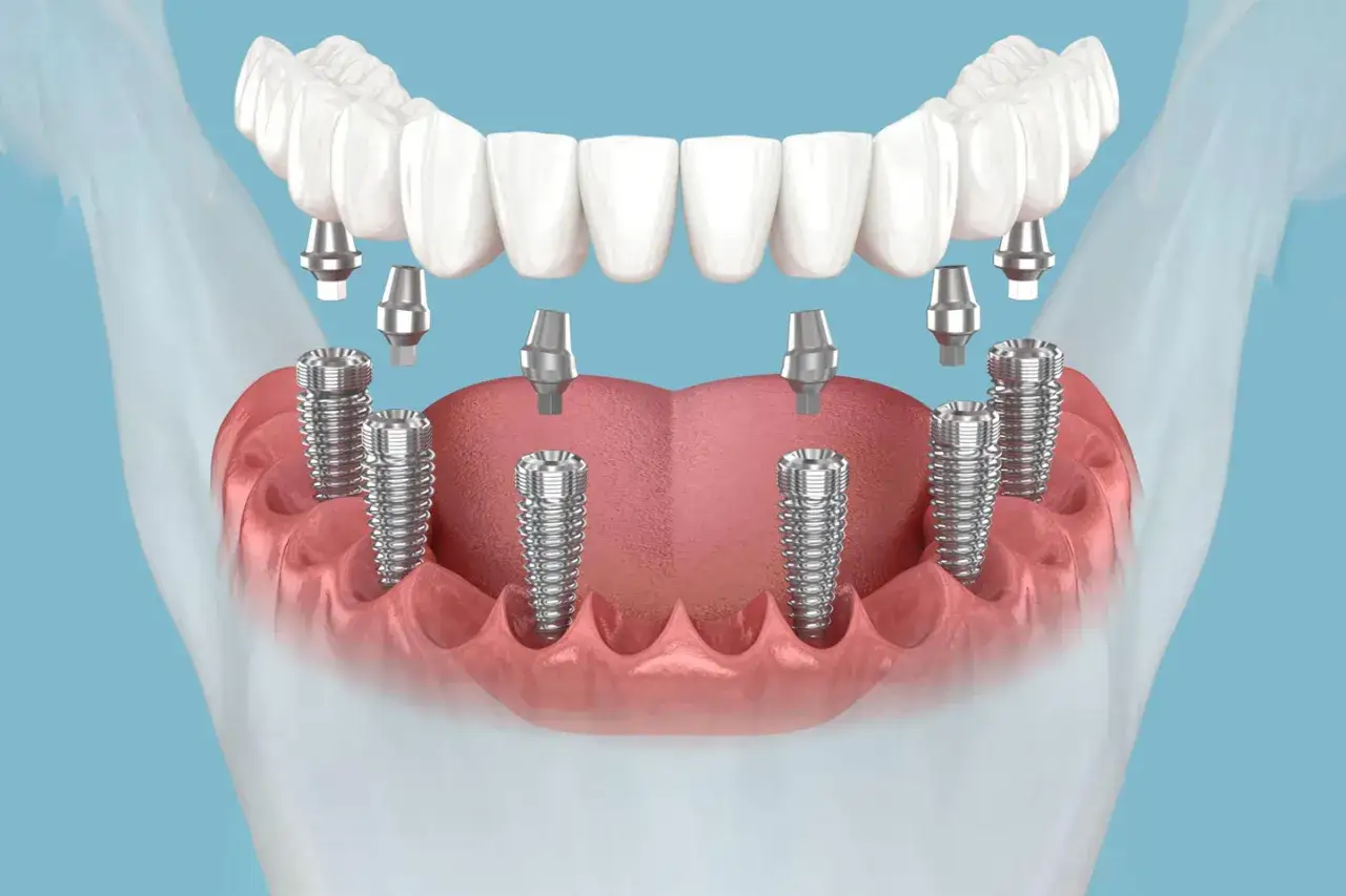 Implantes dentales y pilares listos para una prótesis completa. La técnica all on six ofrece una solución fija y estable para reemplazar dientes perdidos.