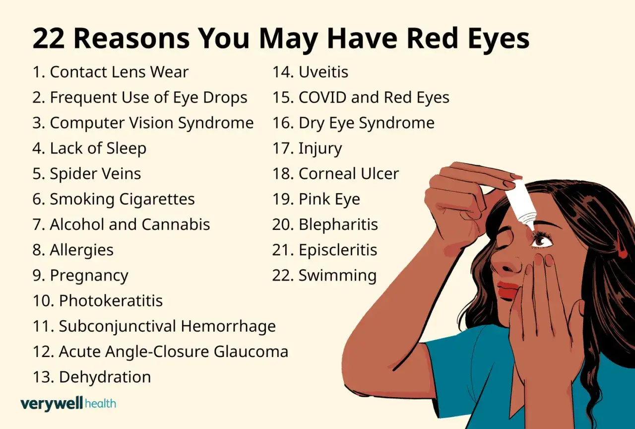 Lista di 22 cause per occhio sempre rosso, tra cui lenti a contatto, allergie e sindrome da visione al computer. Una donna si mette il collirio.