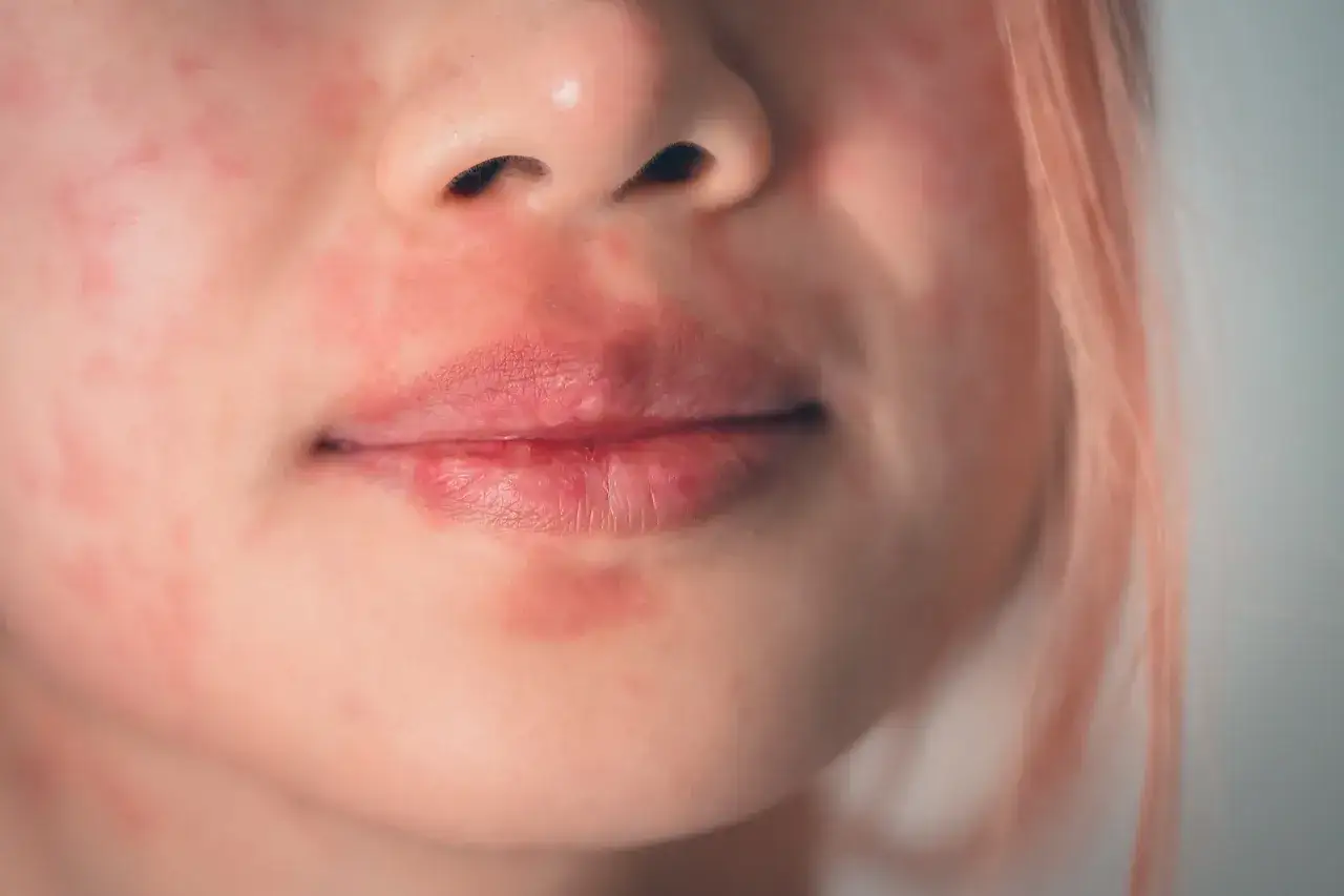 Grafik Vergleich Rosacea, Periorale Dermatitis, Ekzem, Kontaktdermatitis