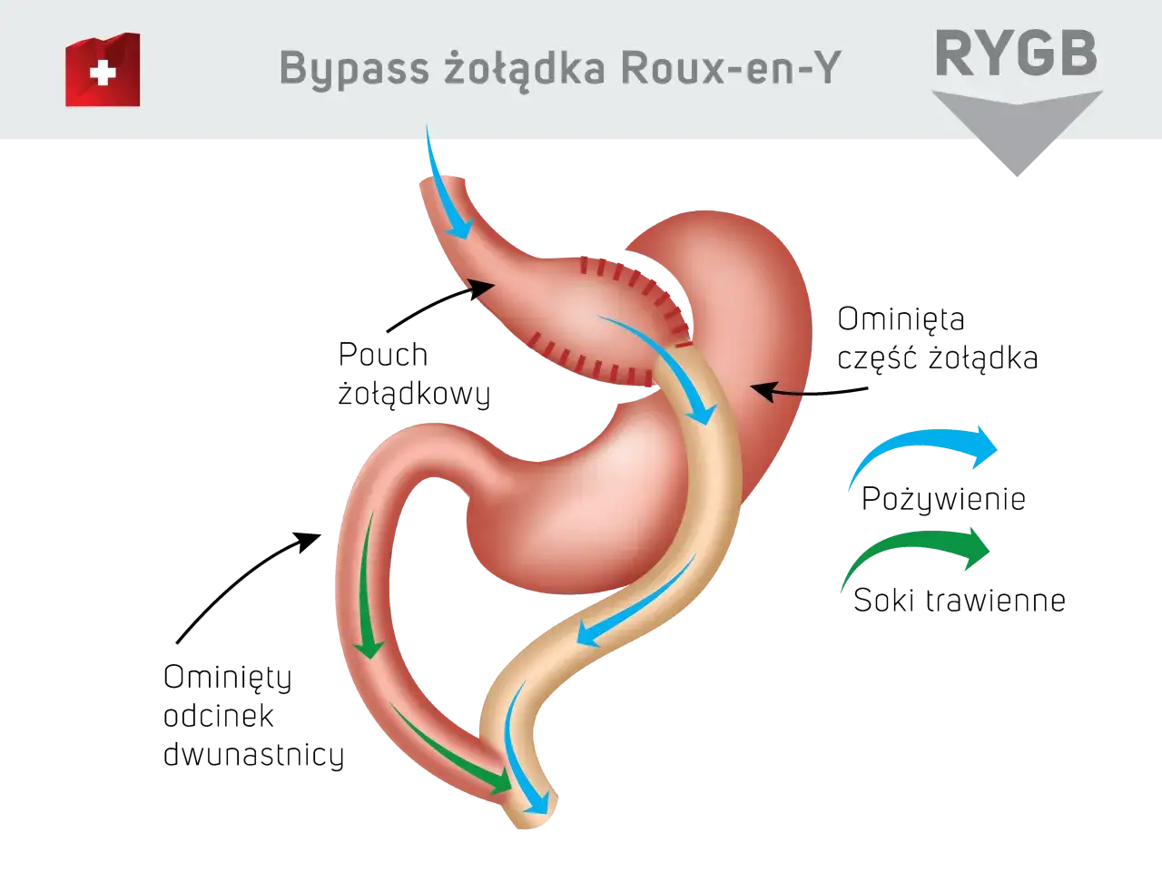 Schemat bajpas żołądka Roux-en-Y. Pokazuje, jak pokarm omija część żołądka i dwunastnicy, kierując się do dalszej części jelita.