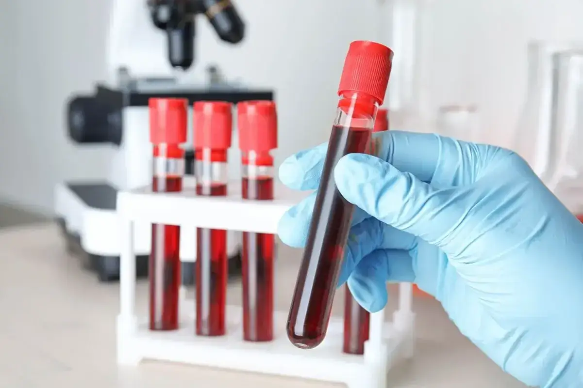 Ręka w niebieskiej rękawiczce trzyma probówkę z krwią. W tle mikroskop i stojak z kolejnymi próbkami. Badania laboratoryjne, ca 19-9.