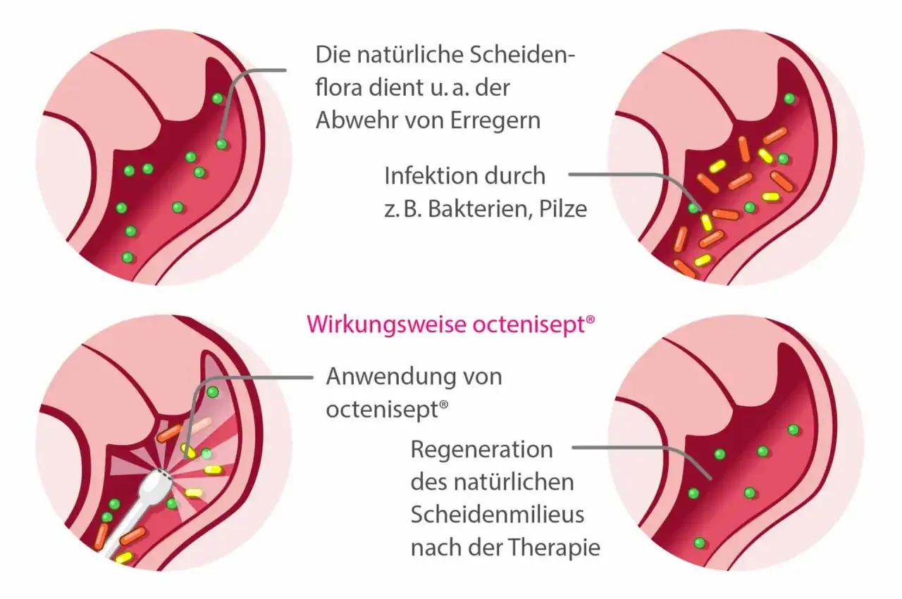 Illustrationen zeigen, wie die nat&uuml;rliche Scheidenflora Erreger abwehrt und wie octenisept&reg; hilft, Infektionen zu bek&auml;mpfen, um das Brennen in der Scheide zu lindern.