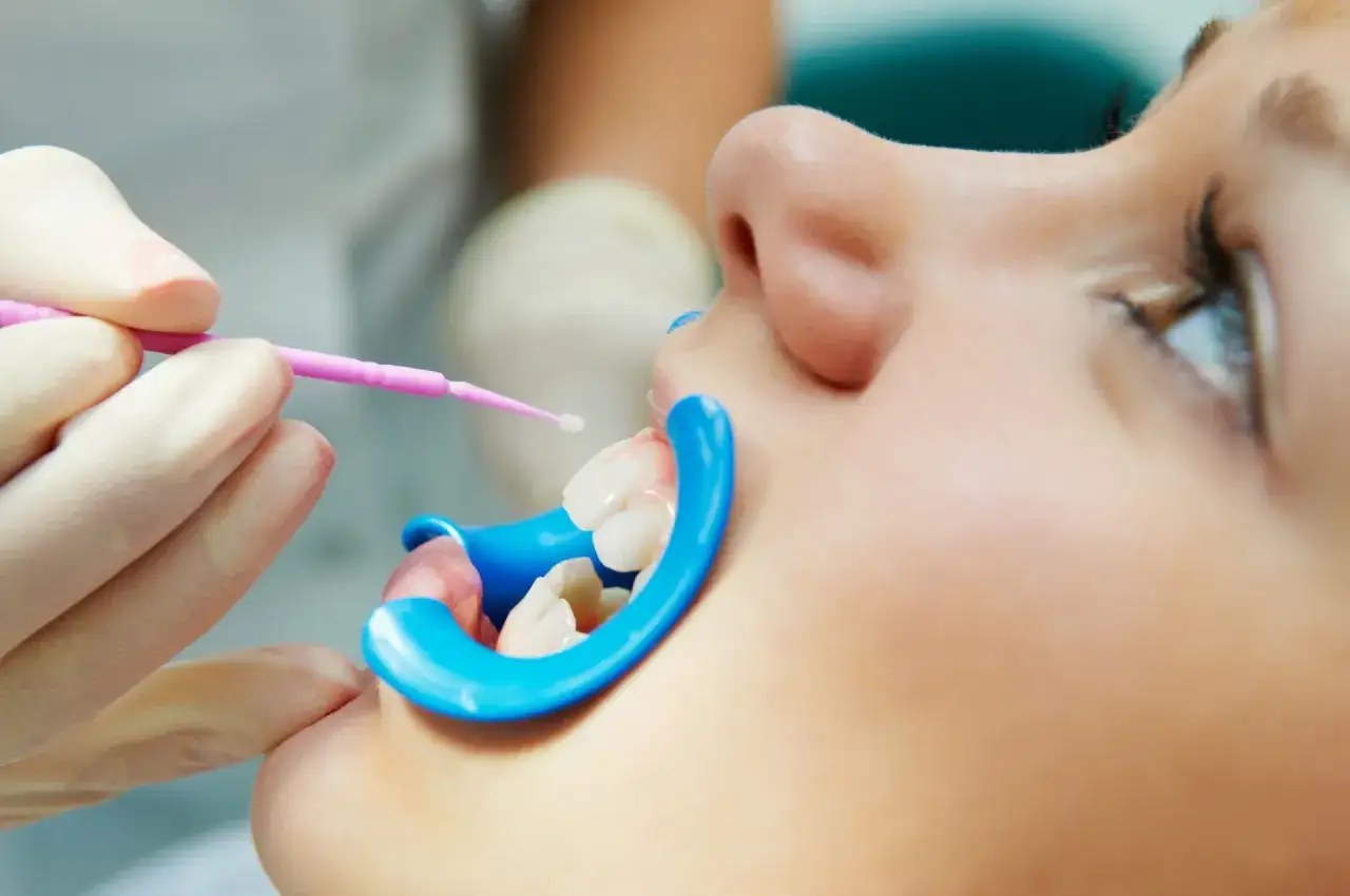 Dentysta aplikuje lakier ochronny na zęby pacjentki.