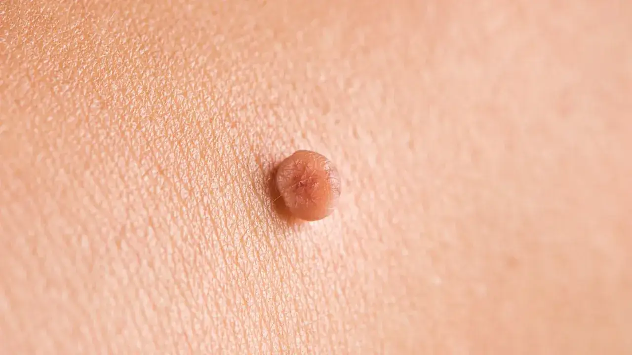Gros plan sur un acrochordon douloureux sur la peau, texture granuleuse visible.