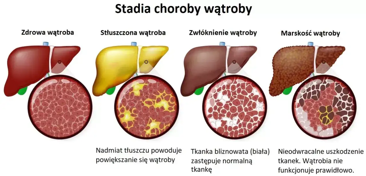 marskość wątroby schemat zdrowa i chora wątroba