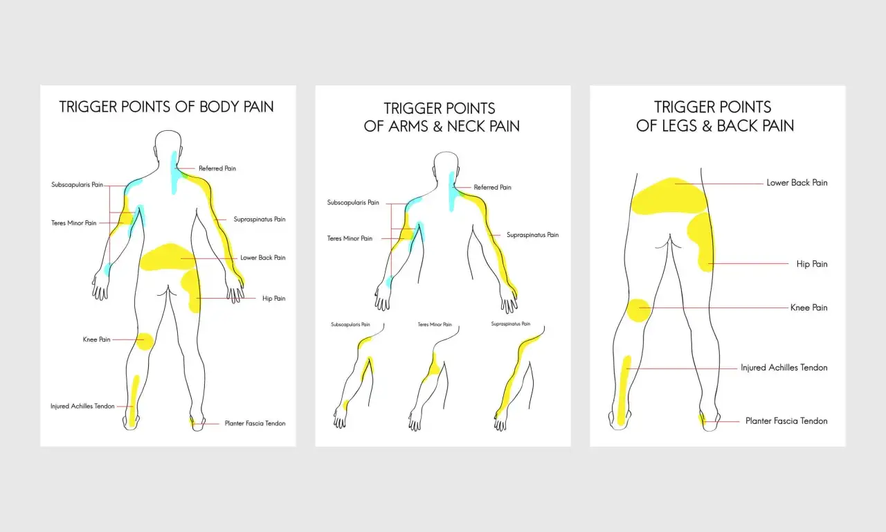 Schémas illustrant les points gâchettes et les douleurs référées du corps, des bras, du cou, des jambes et du dos, utiles pour le massage des points gâchettes.