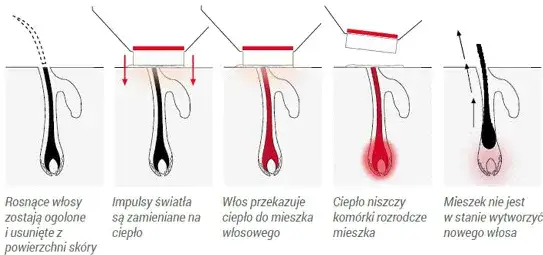 schemat działania lasera na włos