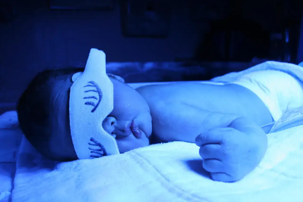 Neonato sotto luci blu per fototerapia, con maschera protettiva sugli occhi.