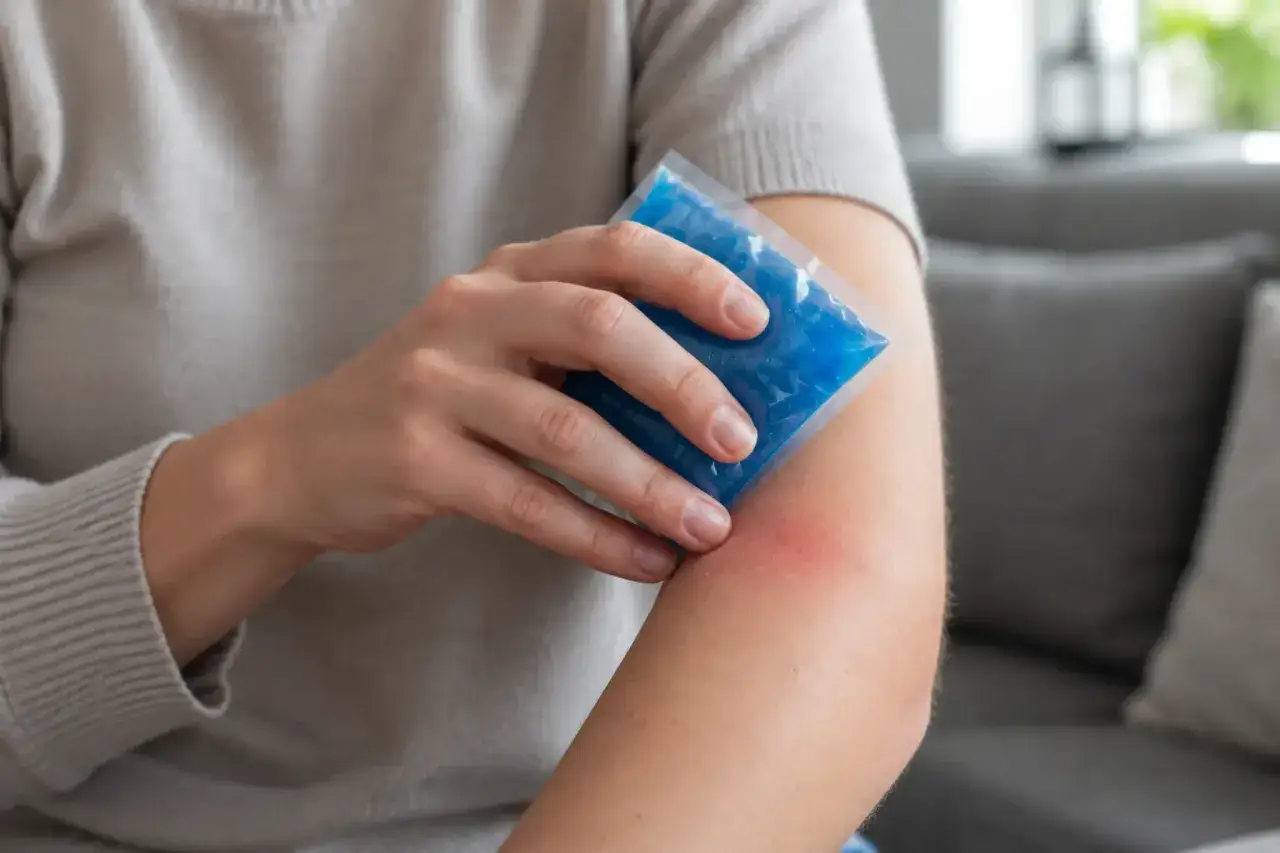 Person k&uuml;hlt starke Schwellung nach Insektenstich am Arm mit einem blauen K&uuml;hlpack.