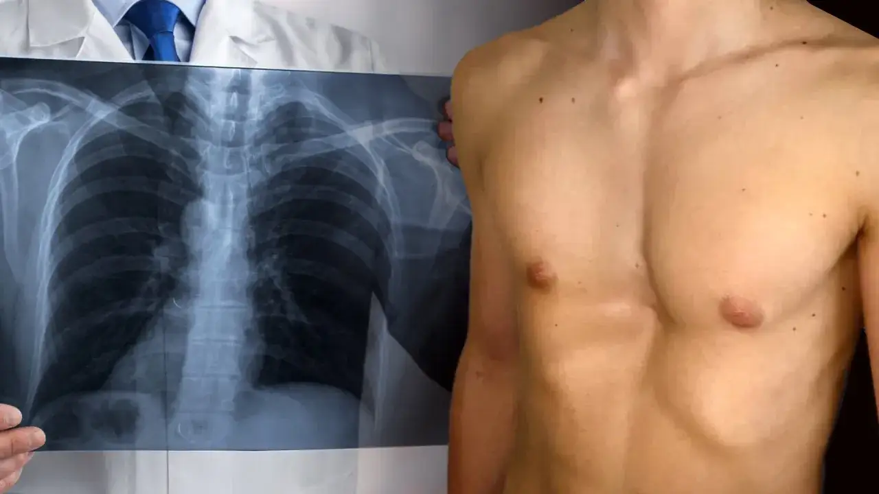 Medico mostra radiografia del torace di un paziente con petto a imbuto, evidenziando la deformità sternale.