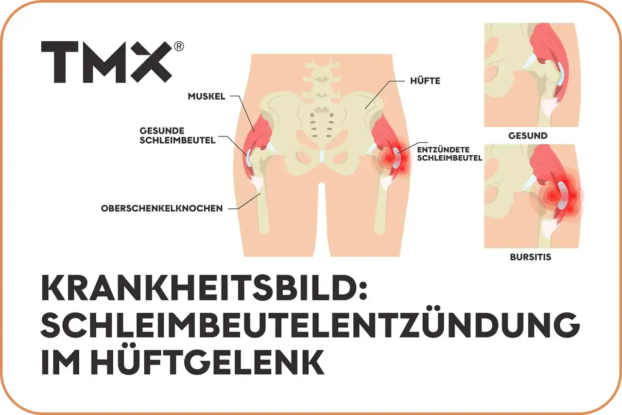 Illustration zeigt das H&uuml;ftgelenk mit gesunden und entz&uuml;ndeten Schleimbeuteln. Bursitis trochanterica als Krankheitsbild.