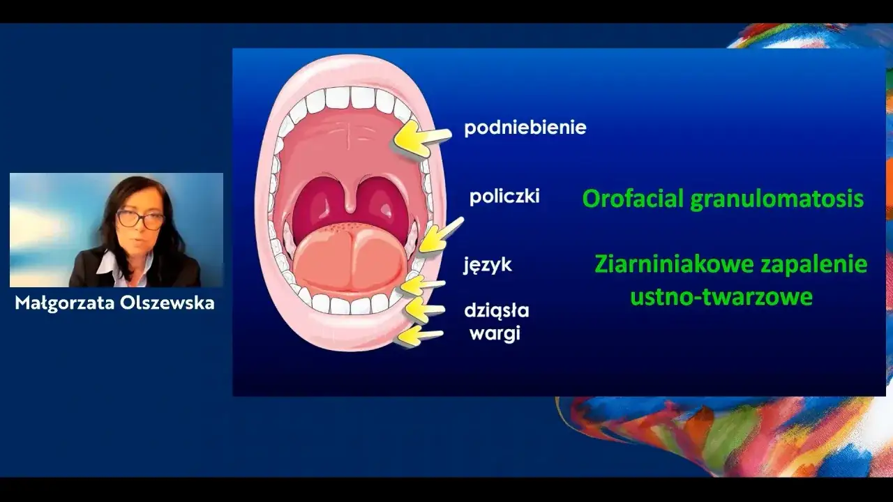 Ilustracja jamy ustnej z zaznaczonymi elementami, w tym dziąsłami i wargami, opisująca ziarniniakowe zapalenie warg.