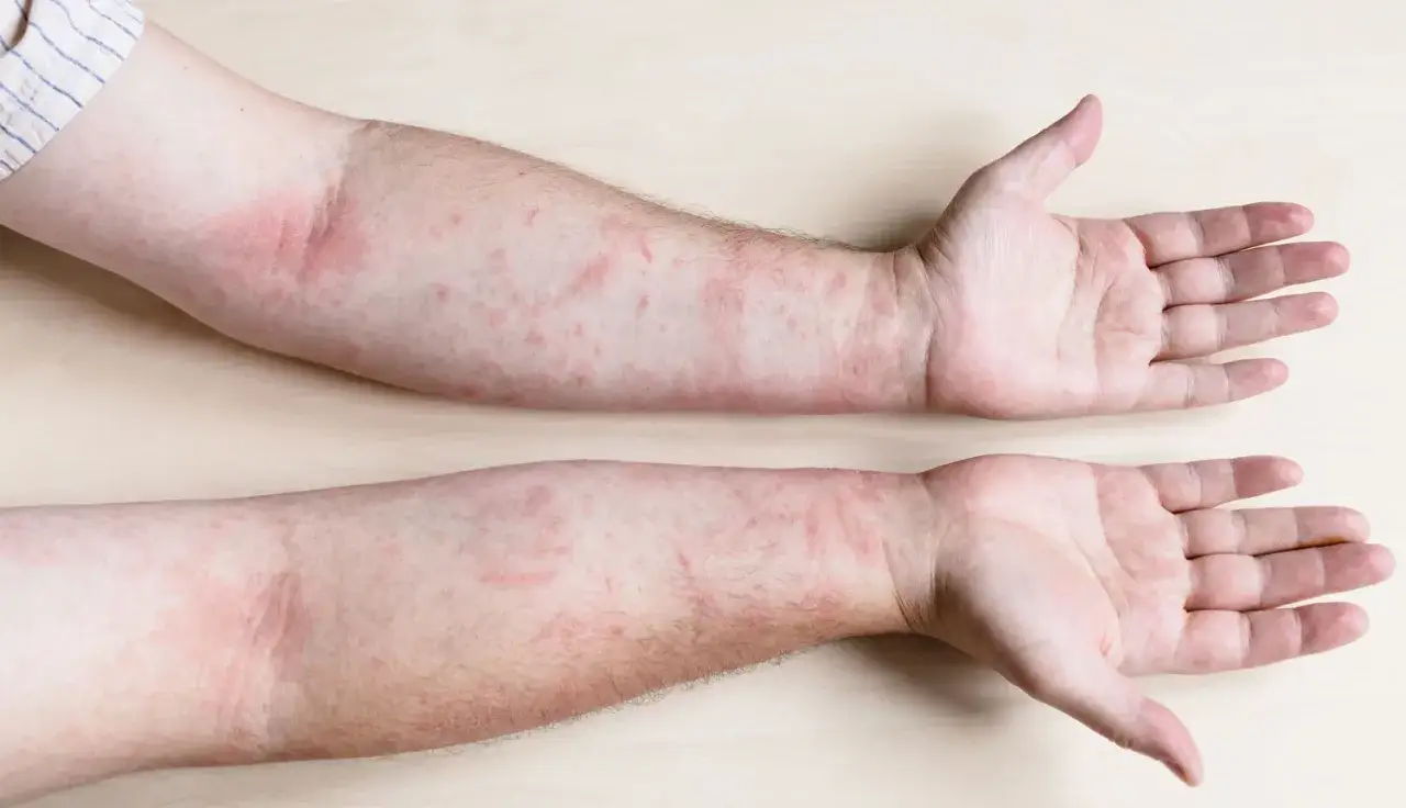 Deux bras couverts de rougeurs et de petites plaques, &eacute;voquant une vive sensation de chatouillement sur la peau.