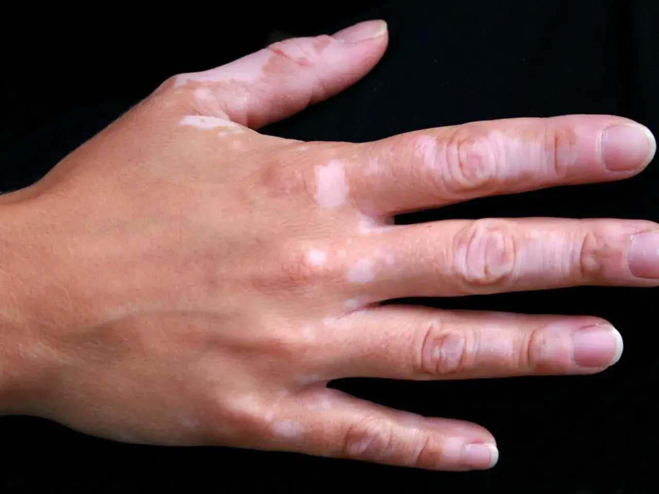 Dłoń z widocznymi jasnymi plamami na skórze, objawami vitiligo.